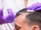 Next-Generation Platelet Treatments for Hair Restoration